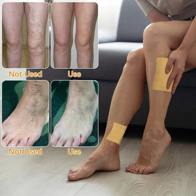 Turmeric Varicose Veins Treatment for Legs Patch, Naturally Relieves Varicose Veins in Legs and Spiders